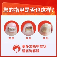 复方聚维酮碘搽剂(亮甲)